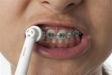 can i use electric toothbrush with braces: Exploring the Ins and Outs of Oral Hygiene with Orthodontic Appliances